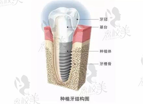 种植牙结构示意图