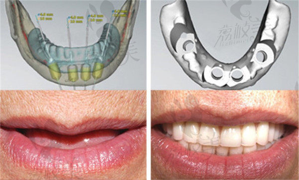 All-ON-4种植牙效果