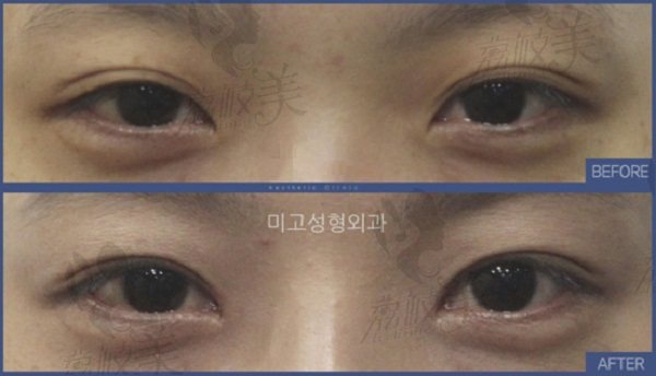 韩国大眼睛高汉雄双眼皮术前术后对比