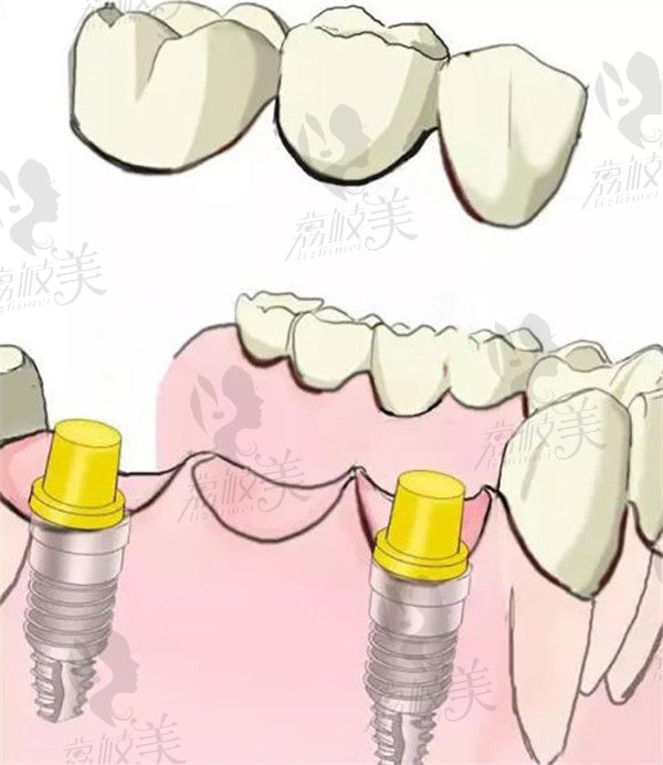 种植体做固定义齿基牙