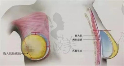 假體的植入方式