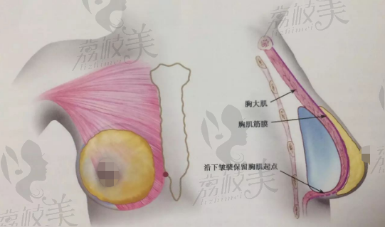 假體的植入方式