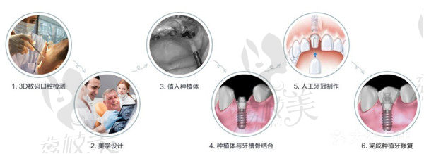 宁波牙博士口腔种植牙过程