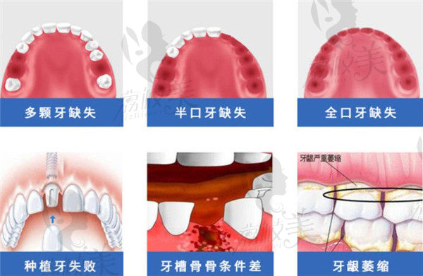 上海雅悦齿科可以种的缺失牙齿种类