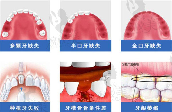 上海雅悅齒科可以種的缺失牙齒種類