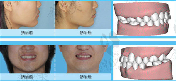 谢贤聚医师牙齿矫正效果