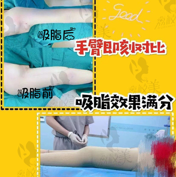 徐鹤然博士威塑吸脂术后成效<span style=