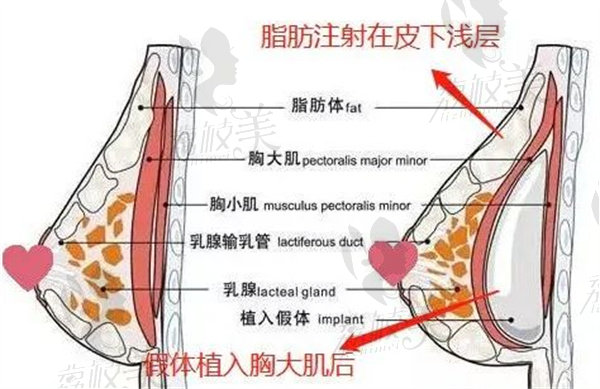 广州华美隆胸植入方式