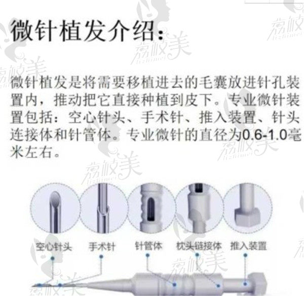 微针植发技术简介