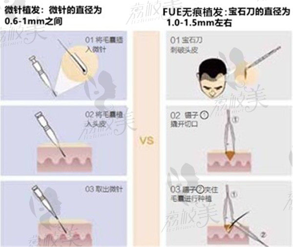 微針植發(fā)和寶石刀植發(fā)的區(qū)別