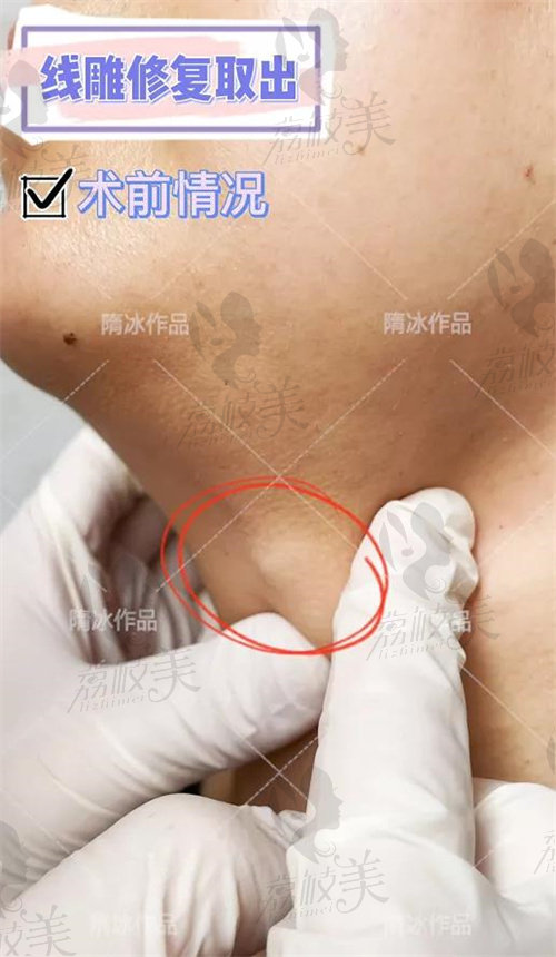 术前颈部明显可见的线头叮起症状