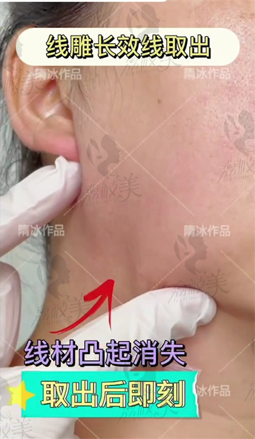 后左右两侧对向按压后线材凸起消失
