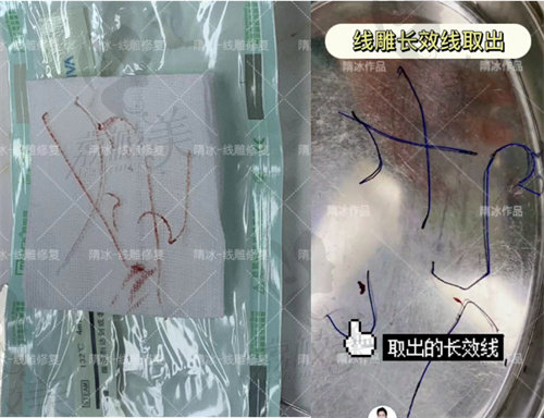 后左右两侧对向按压长效线取出