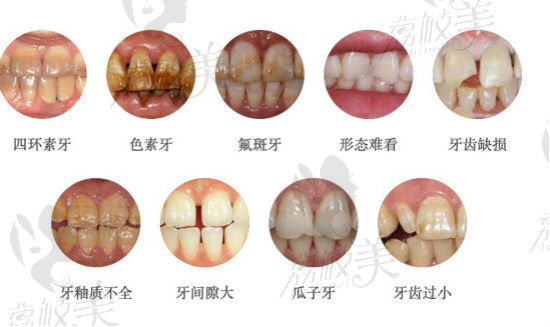 牙齒貼面解決各類牙齒問題