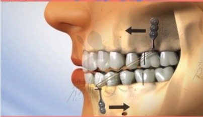 地包天牙齿矫正