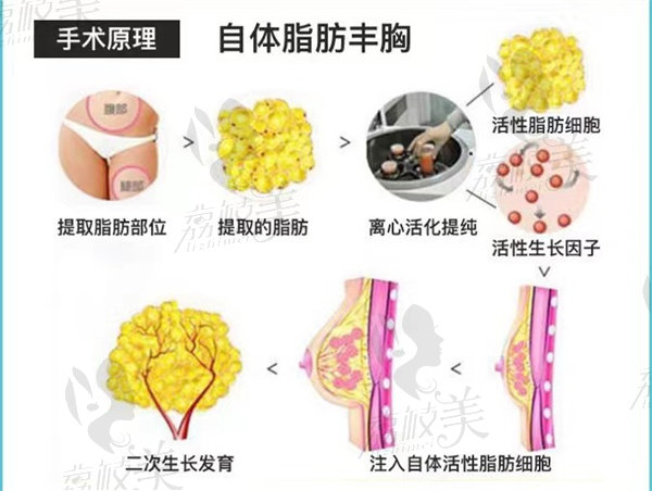 自體脂肪的過程原理