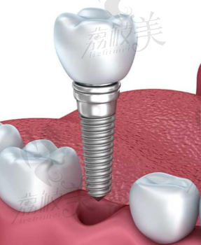 种植牙种植体
