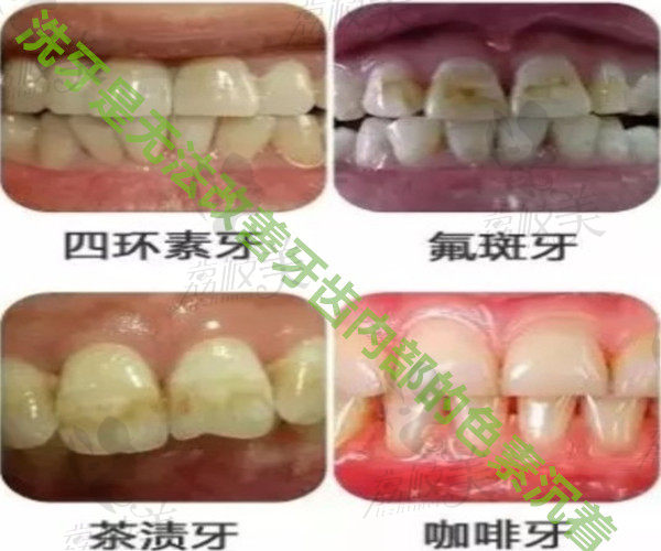 洗牙无法清洁的牙齿类型