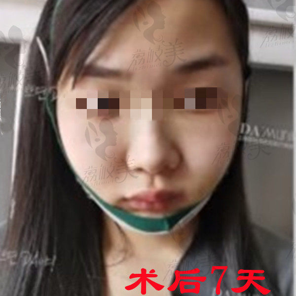 上海美联臣曹栋弼颧骨内推和下颌角整形术后7天