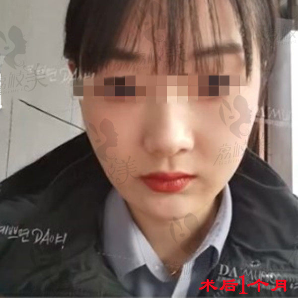 上海美联臣曹栋弼颧骨内推和下颌角整形术后1个月