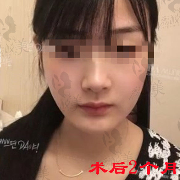 上海美联臣曹栋弼颧骨内推和下颌角整形术后2个月