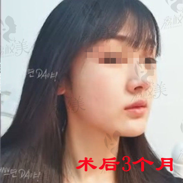 上海美联臣曹栋弼颧骨内推和下颌角整形术后3个月
