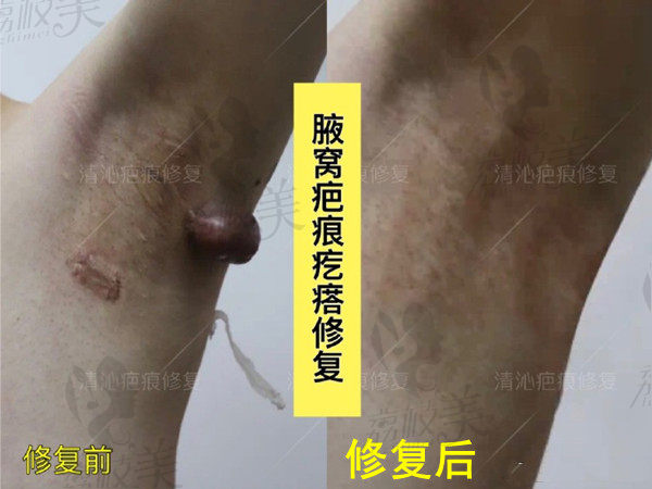 上海清沁腋窝疤痕疙瘩修复