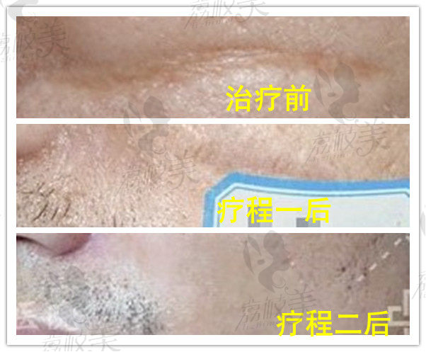上海虹桥医院疤痕科面部凹陷疤痕修复
