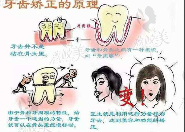 牙齿矫正原理