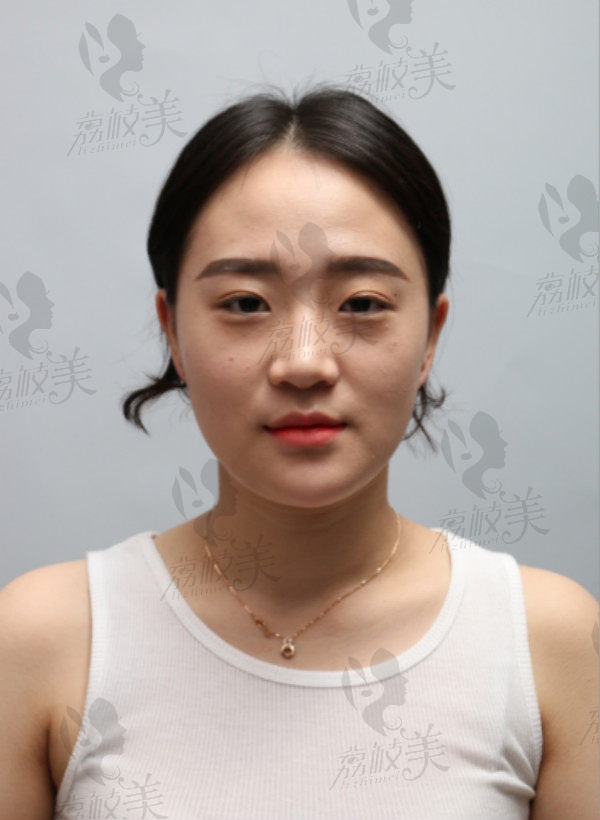 韩国奥森博整形全脸整形术前正面