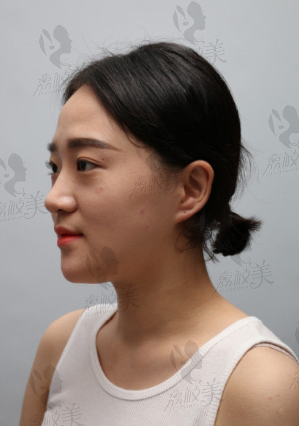 韩国奥森博整形全脸整形术前侧面