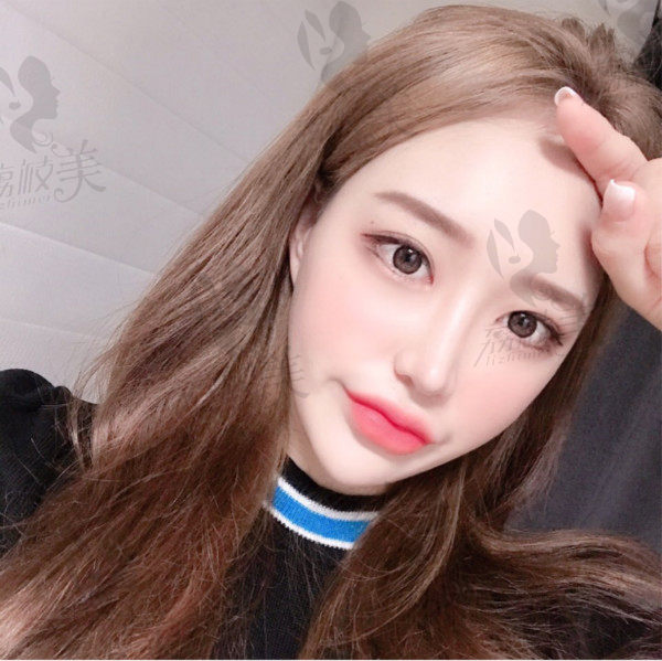 韩国奥森博整形全脸整形术后正面