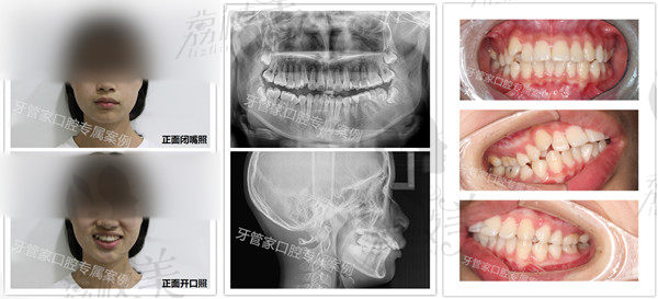 牙齿矫正不用2年,看我在北京牙管家1年3月金属自锁矫正牙齿的效果