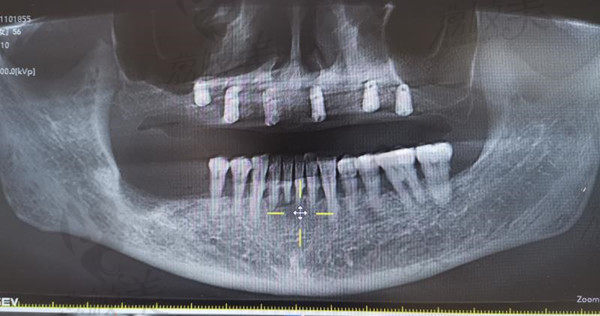 李阿姨种植牙术后CT图