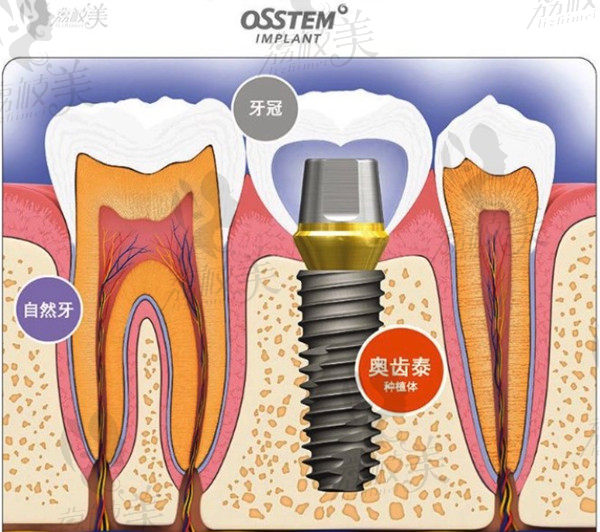 韩国奥齿泰种植体特点