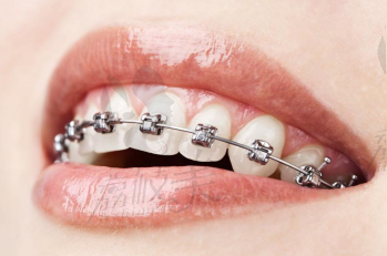 牙齿矫正系列