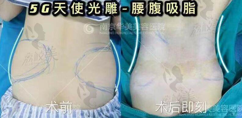 南京华美美容医院5G天使光雕腰腹吸脂