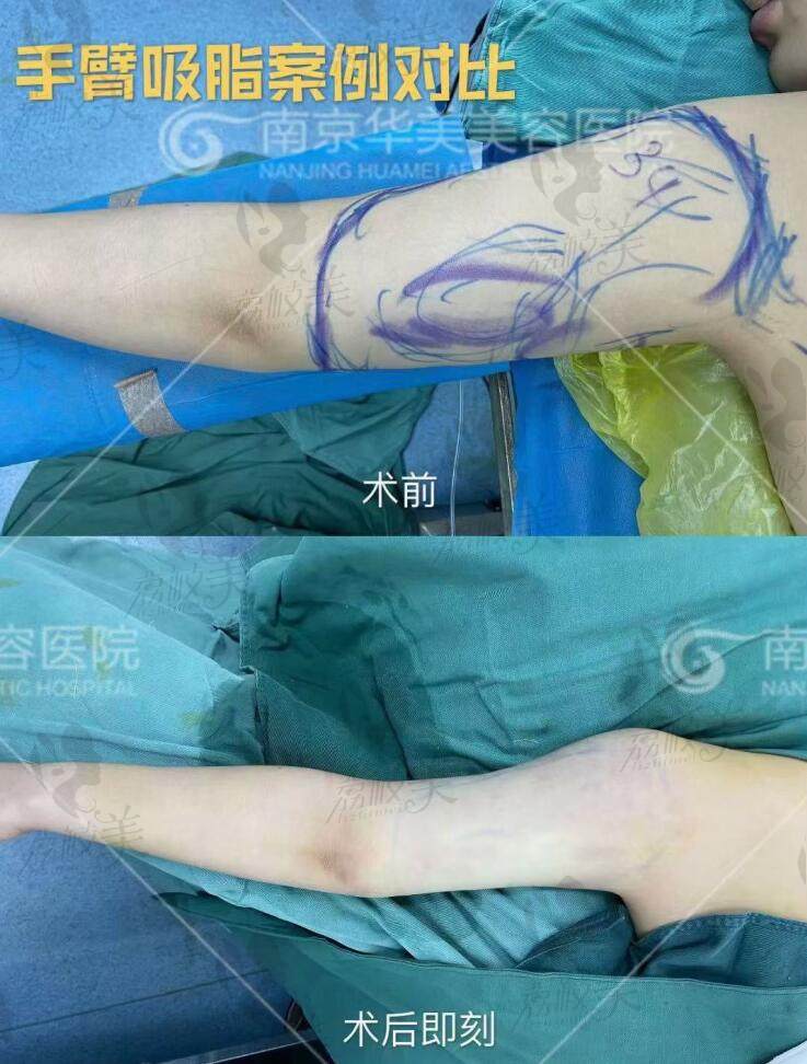 南京华美美容医院5G天使光雕手臂吸脂术后即刻效果