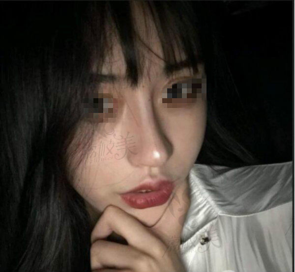 下颌角磨骨术后15天