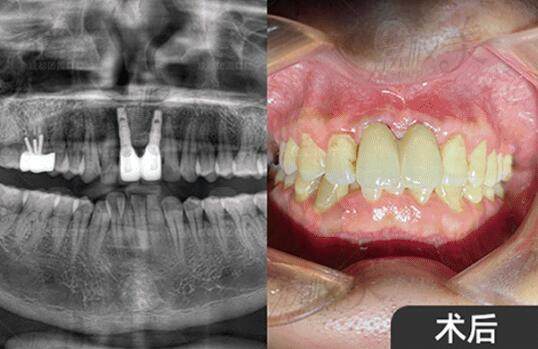 成都畫(huà)美團(tuán)圓口腔種植牙效果