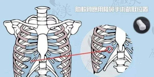 肋骨截取位置示意图