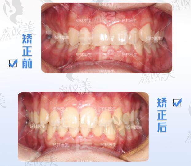 深圳慈恩齒科楊林醫(yī)生深覆合深覆蓋效果對比