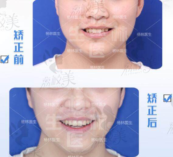 深圳慈恩齒科楊林醫(yī)生深覆合深覆蓋對比