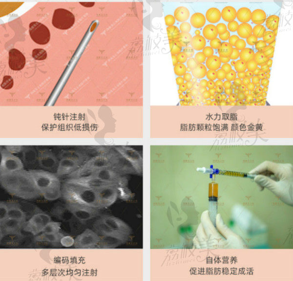  CGF+JET自体脂肪丰胸技术流程