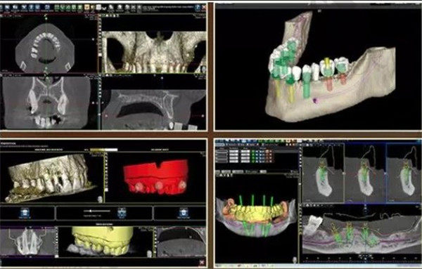 计算机三维模拟种植牙