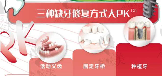 三种种植牙修复方式大pk