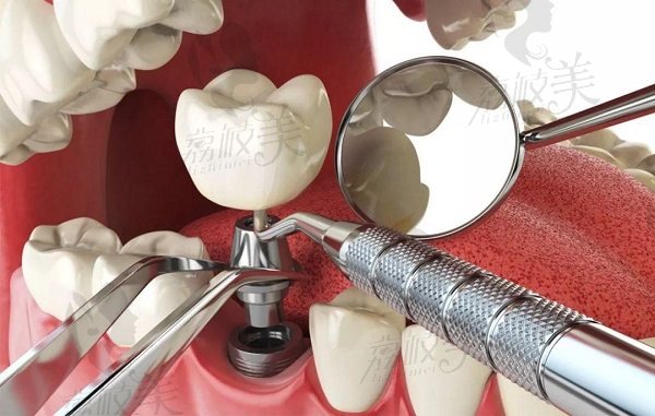 北京劲松口腔医院种植牙怎么样？种植牙多少钱一颗？