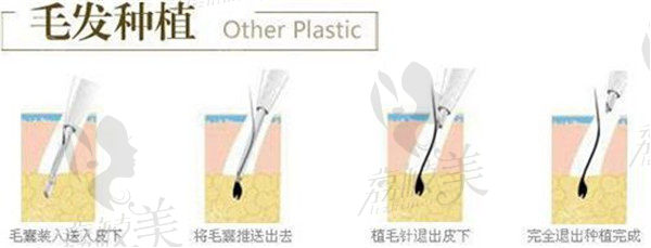 院长毛发种植过程