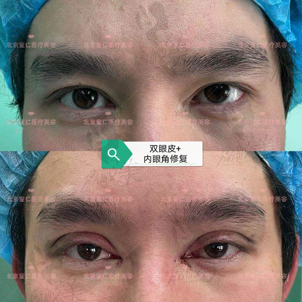 北京童仁医院双眼皮修复术后效果