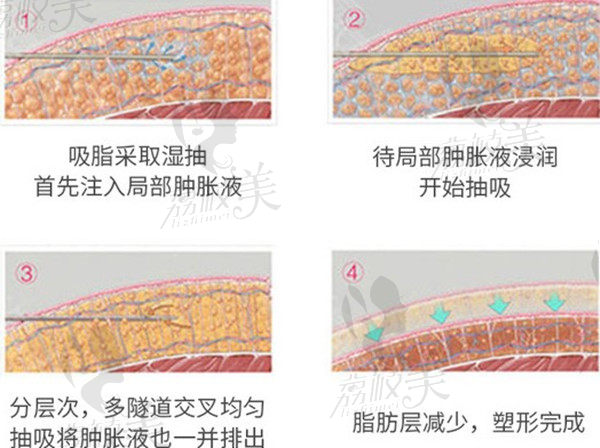 武汉壹加壹吸脂原理